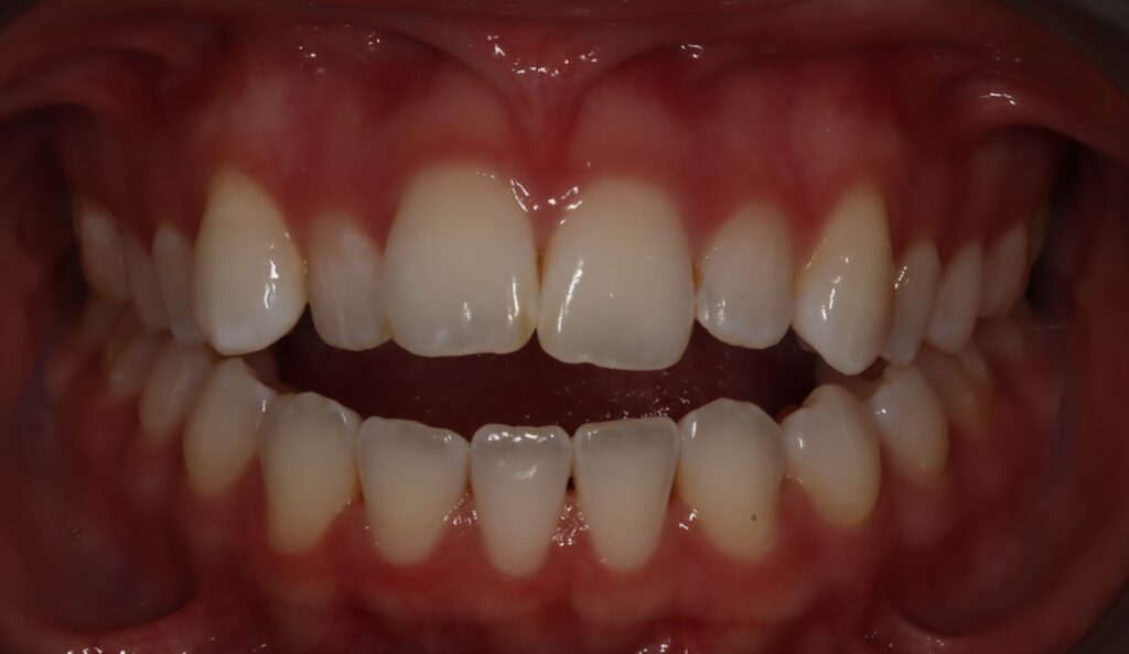 Open bite in an adult female patient in Frisco tx